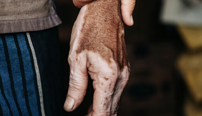 Händer med VITILIGO sökes till reklamkampanj! 