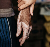 Händer med VITILIGO sökes till reklamkampanj! 