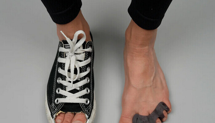 Vi sker dig med Hallux Valgus fr UGC-annons 